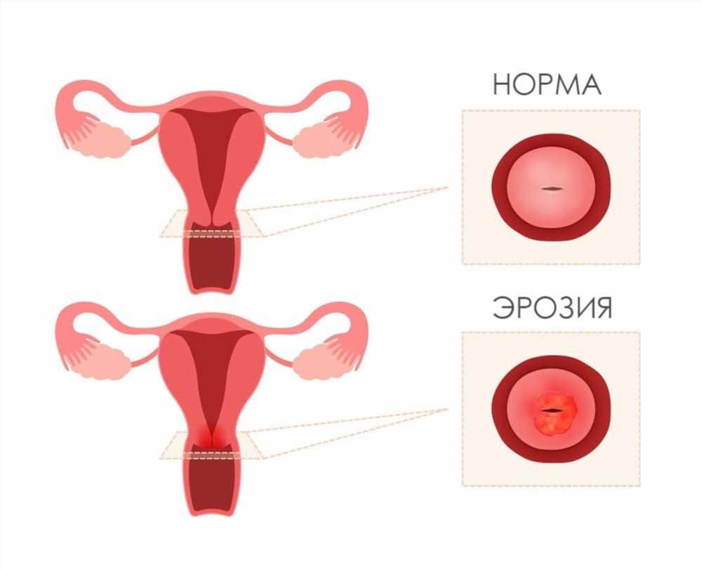 Эрозия шейки матки: причины, симптомы, лечение