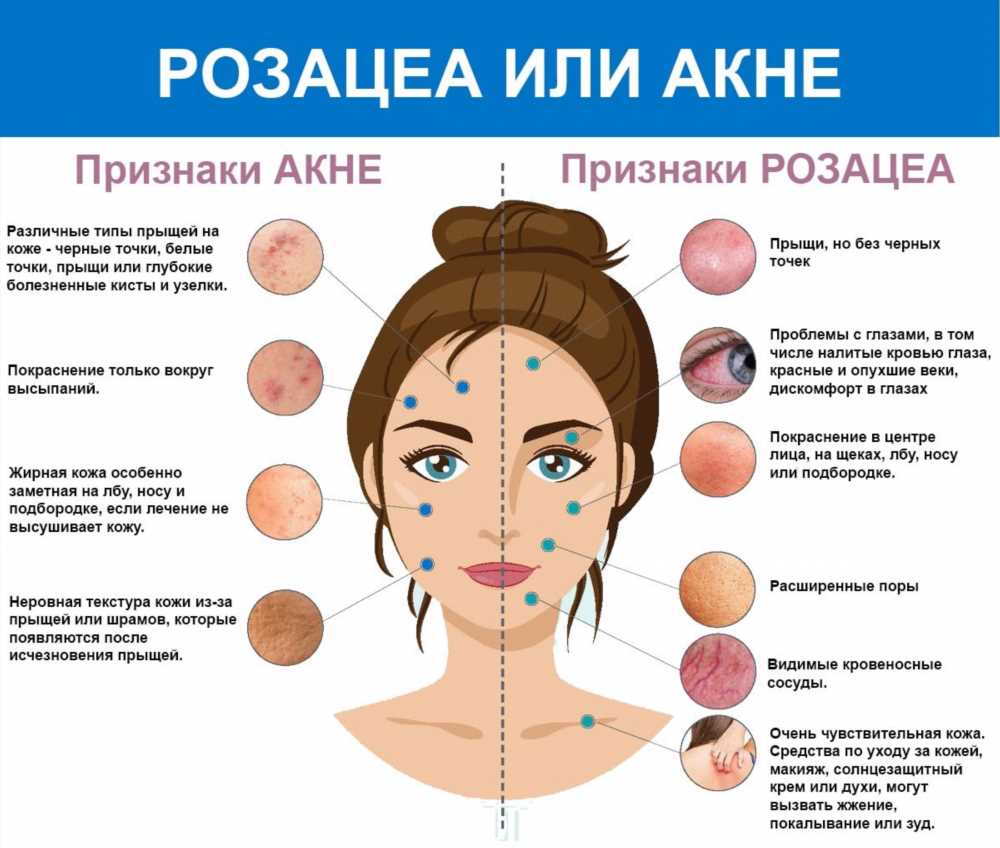 Исследование волчанки: причины и факторы риска, которые важно знать