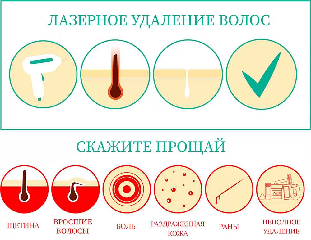 Лазерная эпиляция: Преимущества перед другими методами удаления волос