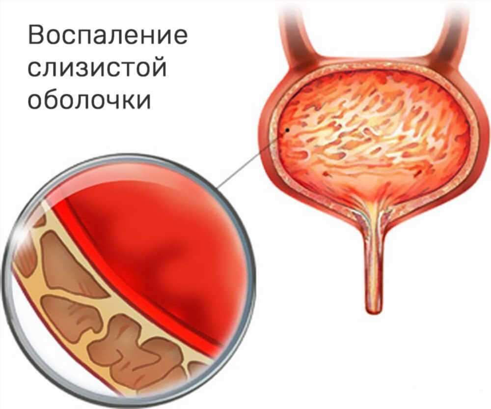 Лечение цистита: Эффективные таблетки и методы профилактики