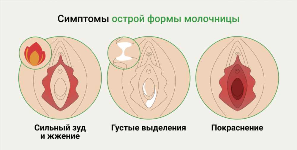 Молочница у детей: Причины, Симптомы, Лечение и Профилактика