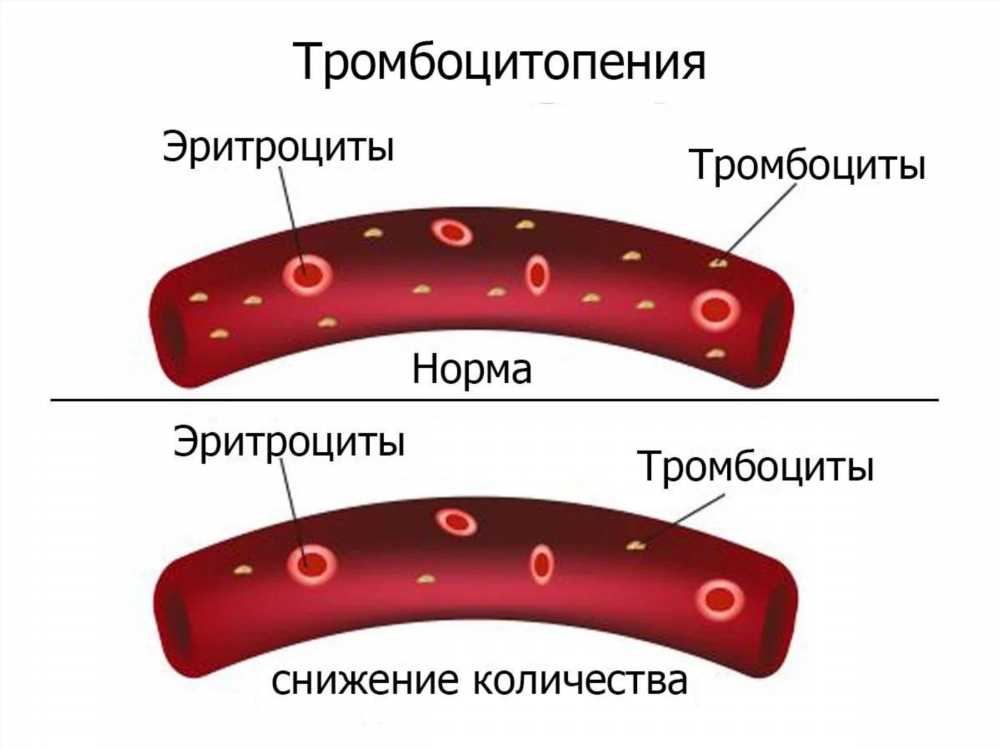 Низкие тромбоциты: причины, симптомы и методы лечения