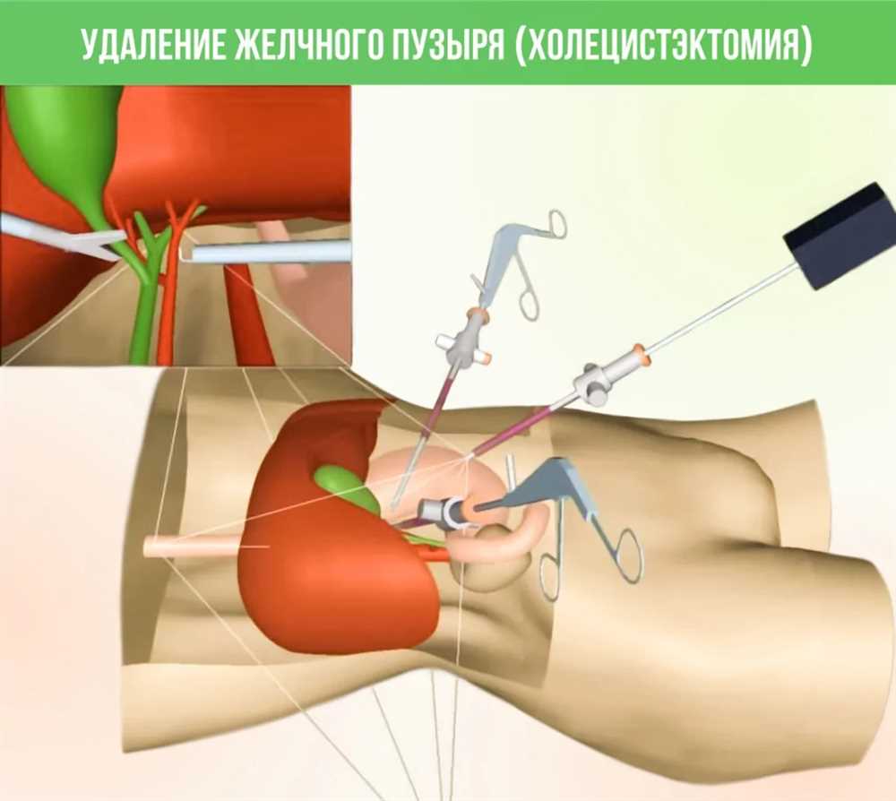 Основания к хирургическому удалению камня в слюнной железе: Причины, Подходы и Последствия