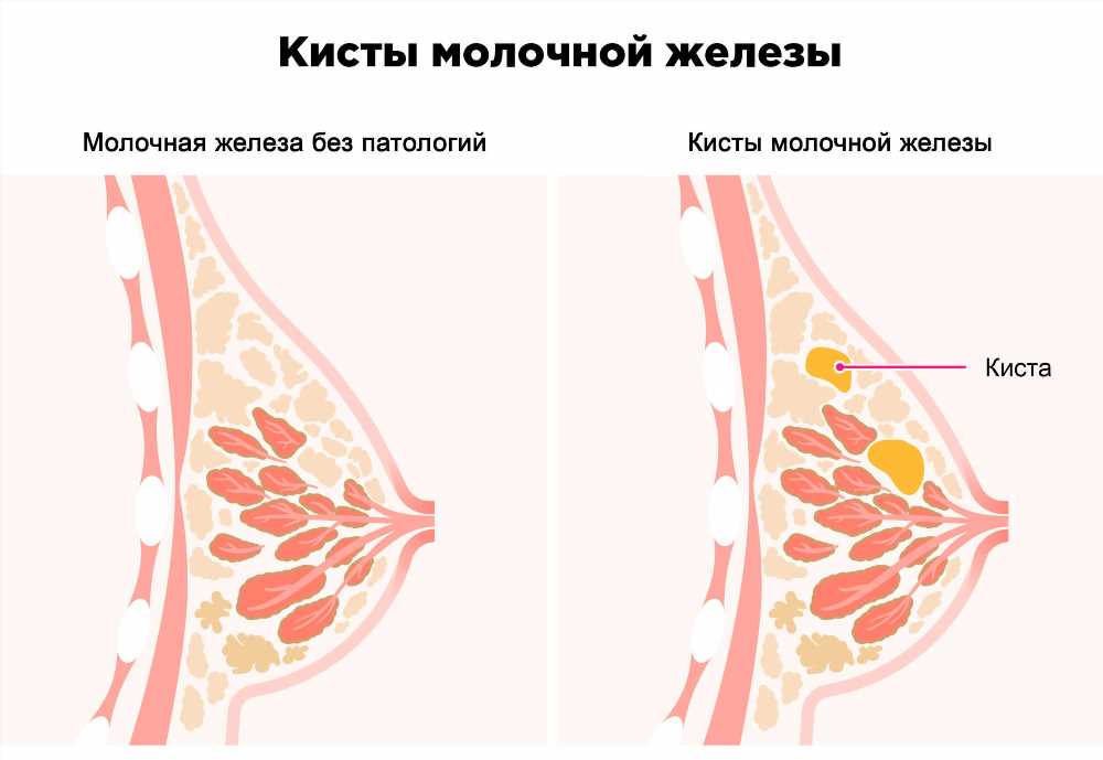 Почему сильно болит одна грудь: причины, симптомы и лечение