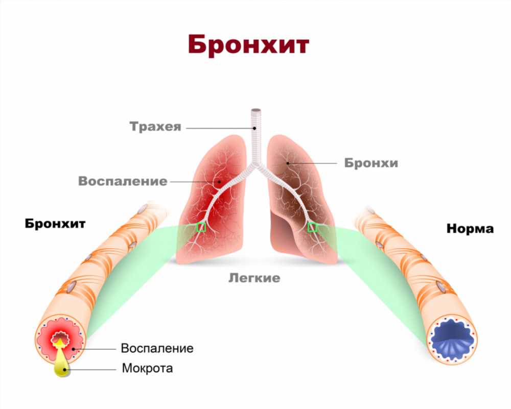 Почему возникает мокрота с кровью: причины, симптомы и лечение