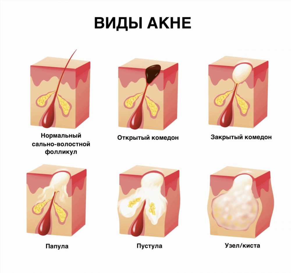 Полное руководство по всем видам высыпаний с фото и методам лечения прыщиков