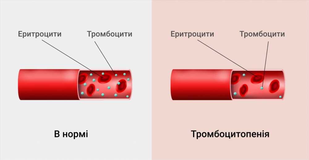 Понижение тромбоцитов: причины и методы увеличения