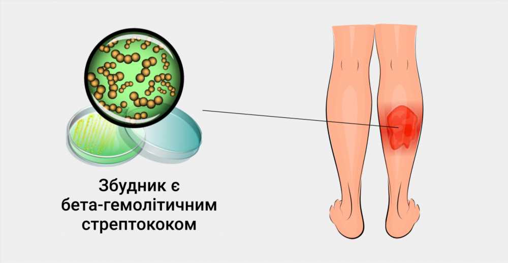 Рожа: Эффективное Лечение Антибиотиками для Очищения Кожи