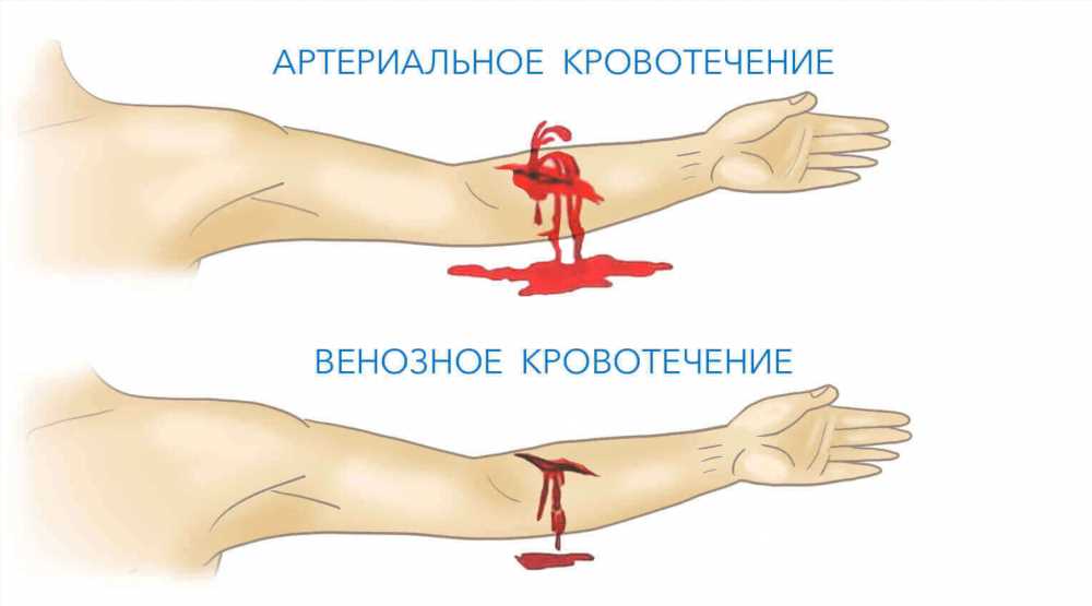 Венозные кровотечения: Понимание, Особенности и Неотложная Помощь