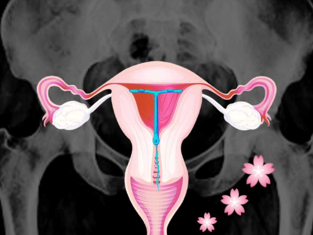 Внутриматочная спираль: Сроки действия, эффективность и влияние на организм