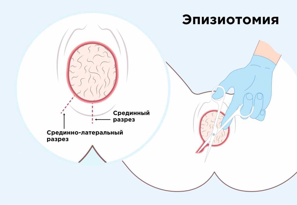 Все о швах после родов: типы, назначение и восстановление