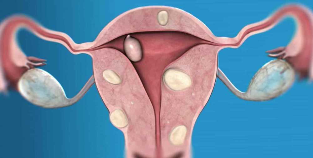 Второй раз миома на 8 недель: Понимание, Лечение и Профилактика